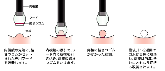 EHL（内視鏡的痔核結さつ術）説明図